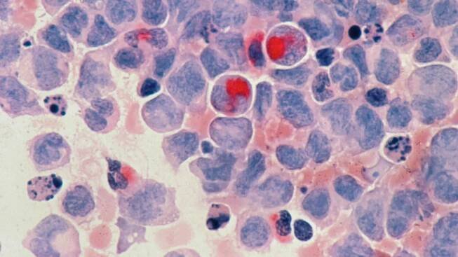 Dostarlimab při msi-h/dmmr kolorektálním karcinomu