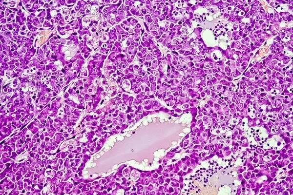 Hepatocelulární karcinom - jater rakovina v rat, 60 x zvětšení — Stock obrázek