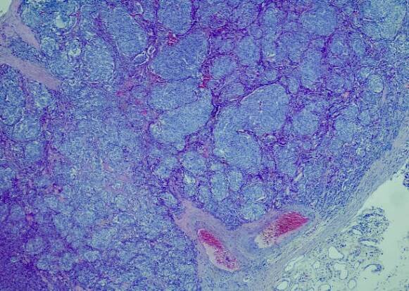 typický karcinoid - micrographs of cancer cells - stock snímky, obrázky a fotky