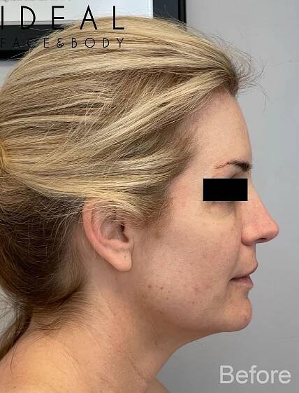 Before Morpheus8 rejuvenation of the face and neck