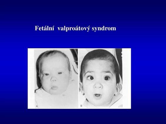 PPT - Teratogenní faktory - vliv na vývoj plodu PowerPoint Presentation - ID:6039506