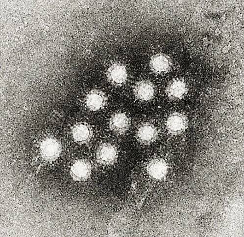 Hepatitída typu A