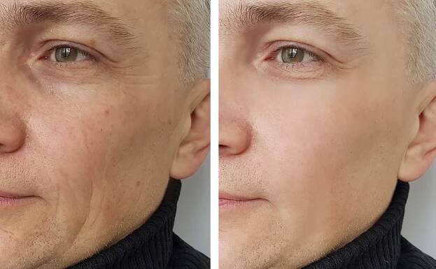 Morpheus 8 treatment — Harley Street Injectables