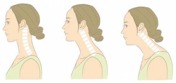 žena s normální krční páteří a rovným krkem - kyfóza stock ilustrace