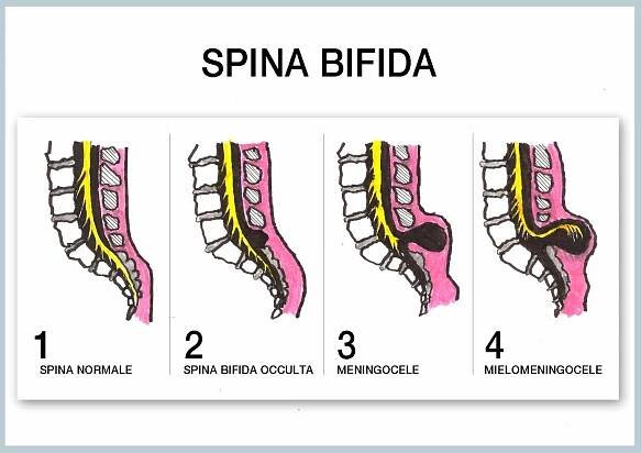 SPINA BIFIDA