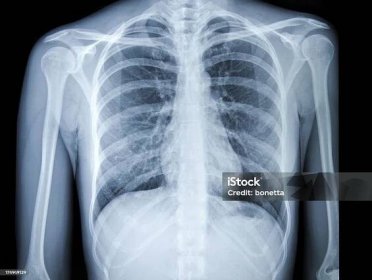 rentgenový snímek hrudníku - Bez autorských poplatků Rentgenový snímek - Vědeckou zobrazovací techniku Stock fotka
