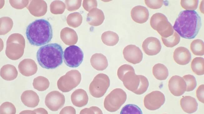 Chronická lymfocytová leukémie