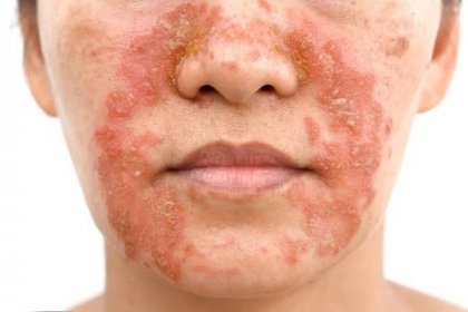 Jak poznat dermatitidu?