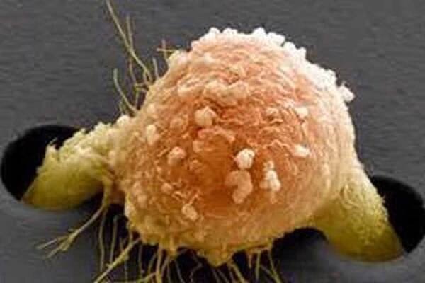 Metastázy melanomu / Melanom