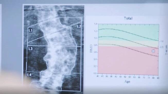 Reducing Fracture in Postmenopausal Osteoporosis: Managing Progression