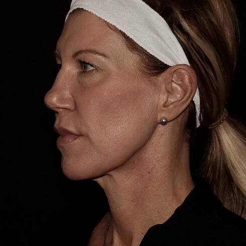 Before Emface SR. Non-surgical facelift. mini facelift. needle free face lift. dermatology of the rockies. longmont. Boulder. Erie. Best medical spa near me.