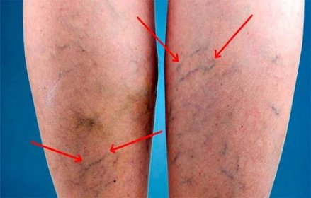How to treat varicose veins (varicose veins) of the lower extremities with folk remedies
