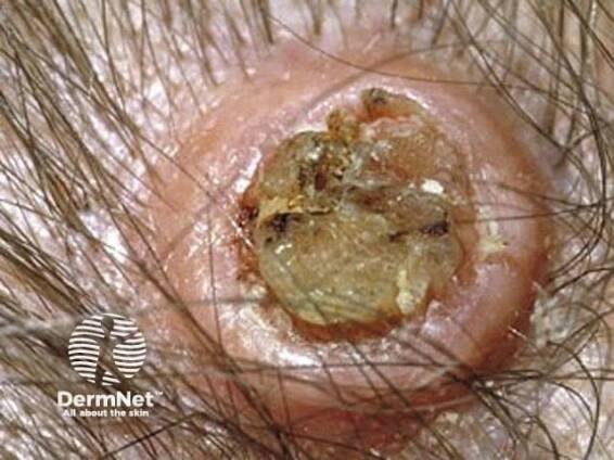 Keratoacanthoma: A Complete Overview with Images - DermNet