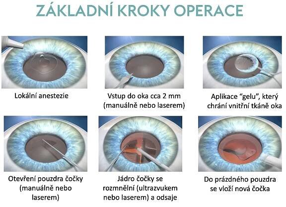 Komplikace operace šedého zákalu a výměny nitrooční čočky