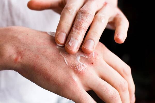 Psoriasis Awareness Month