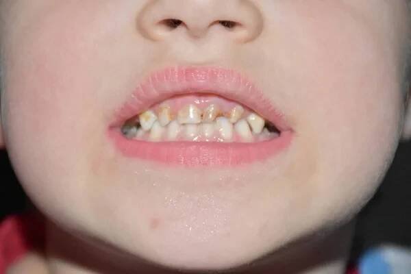 Špatné zuby v dítěti a caries, — Stock obrázek