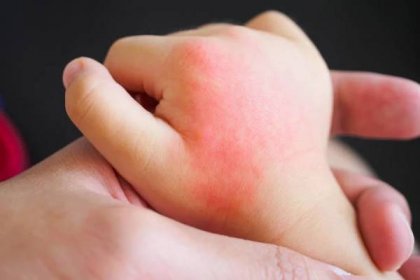 dětská ruka s kožní vyrážkou a alergií s červenou skvrnou způsobenou kousnutím komárem - allergies kids - stock snímky, obrázky a fotky