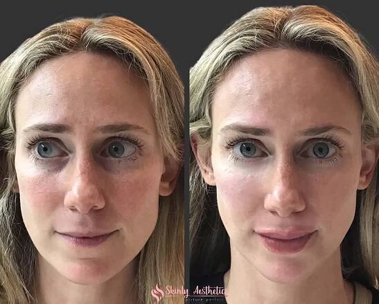 juvederm dermal filler lip injection