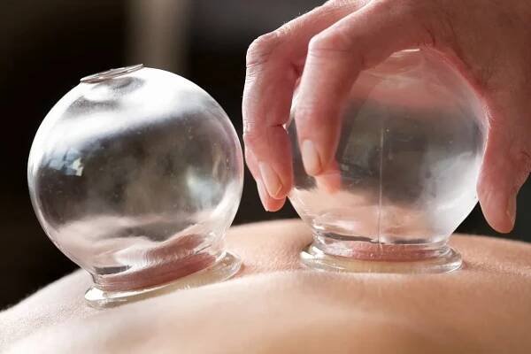 Bellevue Chinese Cupping Therapy, serving Seattle & Seattle's Eastside