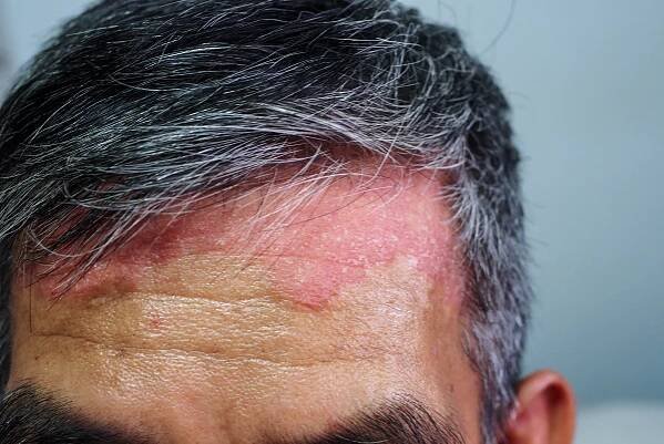 psoriasis-capillitii.webp