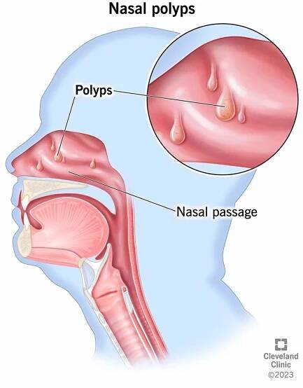 Nasal polyps forming inside of nasal passage.