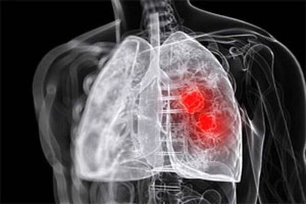 Plicní absces, co to je a jak se léčit? / Absces | Užitečné informace a tipy na péči o sebe. Zdraví, výživa a další.