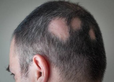 Alopecia areata - ložisková alopecie