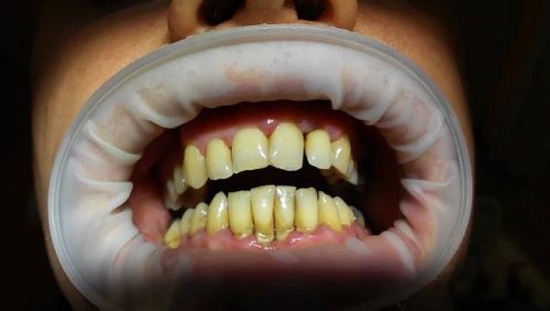 je důsledkem špatné ústní hygieny a poškozuje zubní sklovinu, vzniká zubní kaz.