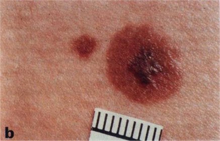 melanom – Dr Konrad Pharma