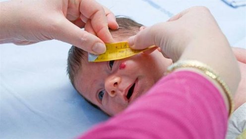 Hemangiom postihuje každého desátého kojence. Je třeba ho začít léčit včas