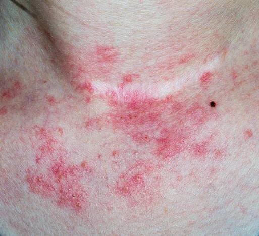 ekzém kůže na krku - atopická dermatitis - stock snímky, obrázky a fotky
