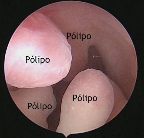 pólipos y miomas