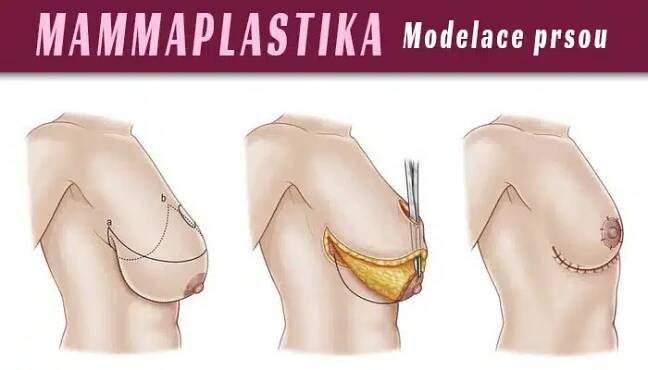 Mammaplastika: co očekávat od modelace prsou