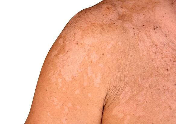 Tinea Versicolor Natural Remedies