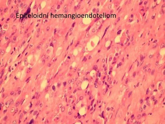 Epiteloidní hemangioendoteliom 
 