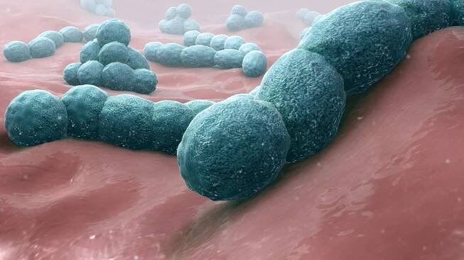 Bacterial pneumonia