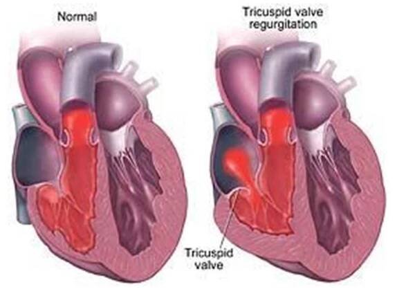 Valve Surgery Malaysia: Treatment for Valve Disease - CVSKL