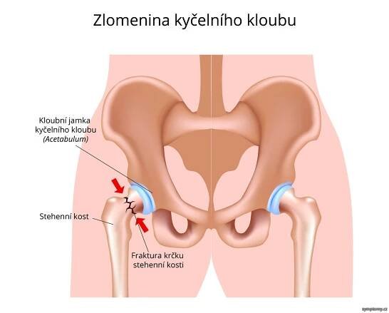 Zlomenina kyčelního kloubu - příznaky a léčba