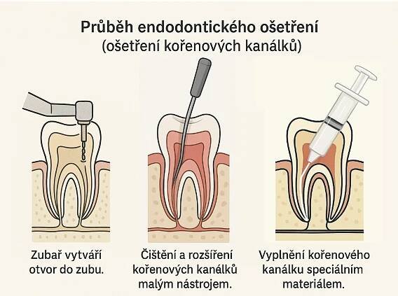 Vše o zubním váčku – jak vypadá, příčiny, příznaky a jak se ho zbavit | Zodpovime.cz