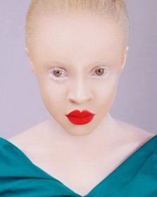 Can People With Albinism Dye Their Hair? Unveiling The Facts.