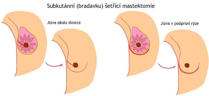 Subkutánní bradavku šetřící mastektomie