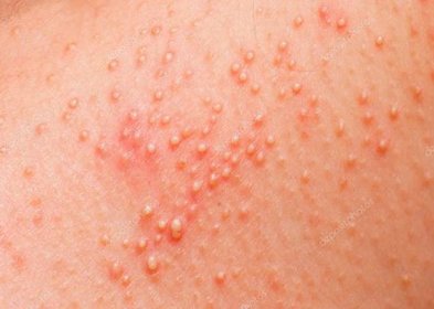 Stáhnout - Alergická vyrážka na těle pacienta — Stock obrázek