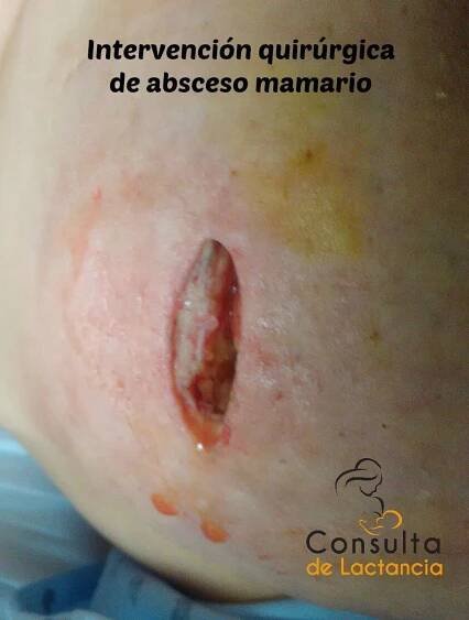 intervención quirúrgica de absceso mamario