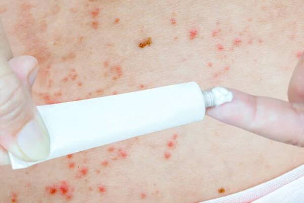 šindele na kůži a medicína farmaceutické bílé trubice balení. herpes zoster je zvednuté červené hrboly a puchýře způsobené na těle. lékařská léčba konceptu infekce virem varicella-zoster. - kopřivka - stock snímky, obrázky a fotky