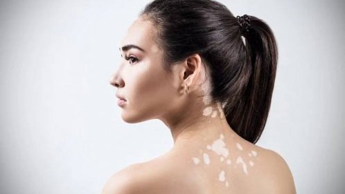 Jak poznáte nemoc s názvem vitiligo? Napoví vám bílé skvrny na kůži