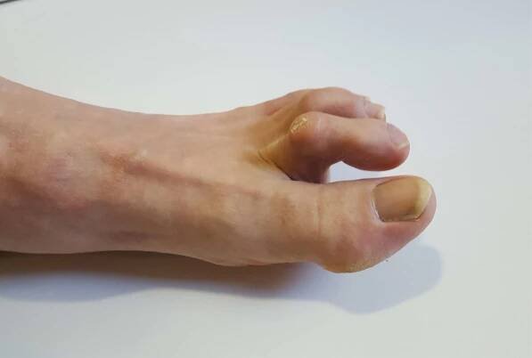 Hammertoe.jpeg