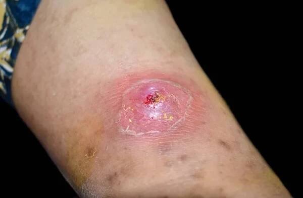 Hrozící absces s okolní celulitidou nebo stafylokokovou / streptokokovou kožní infekcí u pravé nohy asijského barmského pacienta. Boční pohled. Izolováno na černé. — Stock obrázek