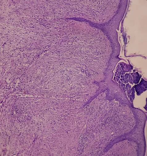 tkáň z ocasu kočky: neurofibrom, benigní novotvar buněk ve tvaru vřetena s vlnitými jádry. neurofibromatóza, mikroskopický 40x pohled. - neurofibromatóza - stock snímky, obrázky a fotky