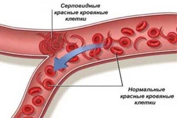 Srpová buněčná anémie / Anémie | Užitečné informace a tipy na péči o sebe. Zdraví, výživa a další.