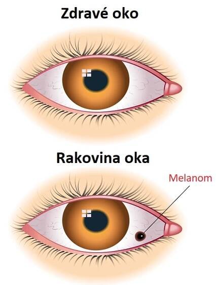 Melanom oka - ilustrace